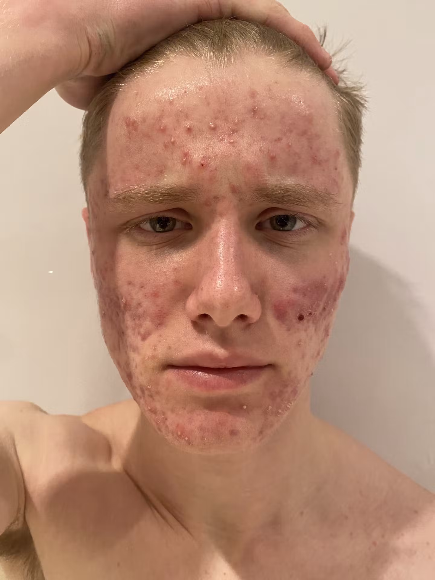 acne image 1 January