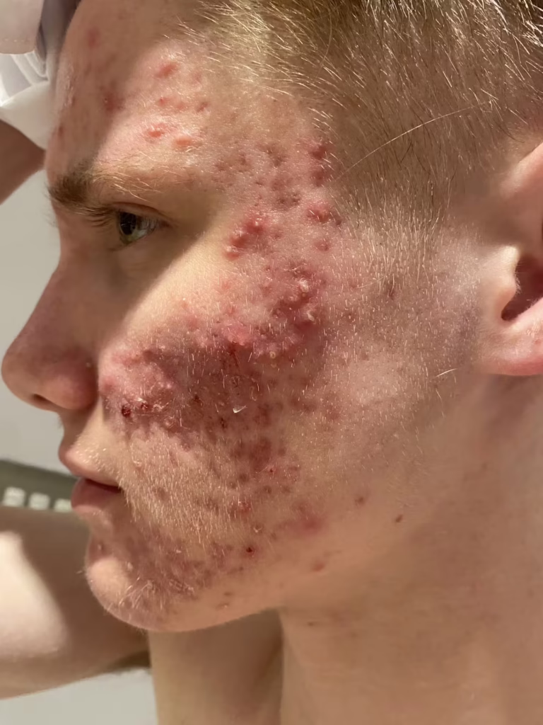 acne image 2 January