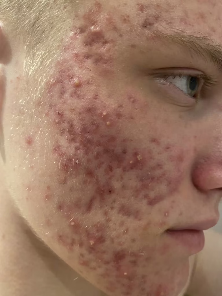 acne image 4 January