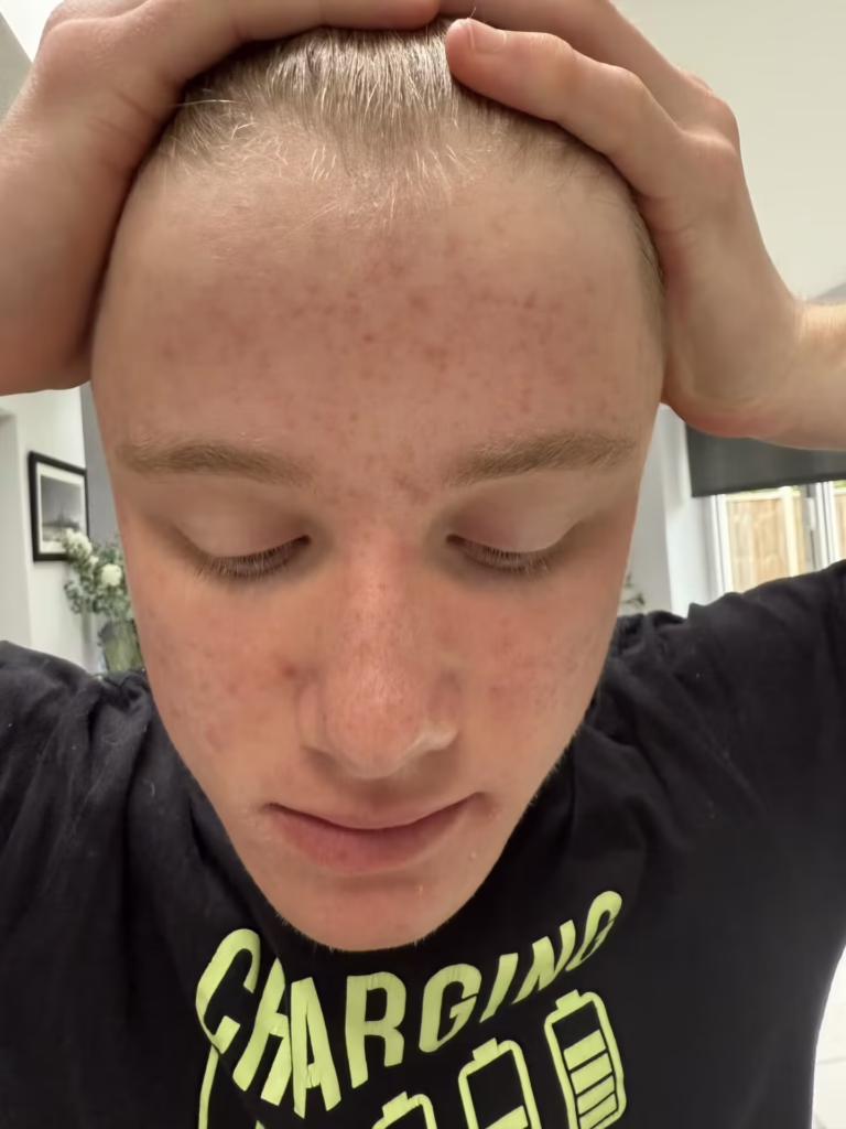 acne image 1 May