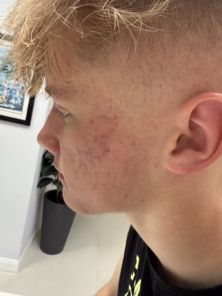 acne image 2 May
