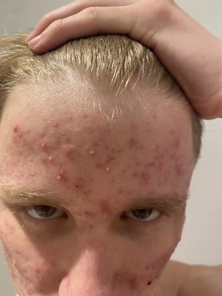 acne image 3 January