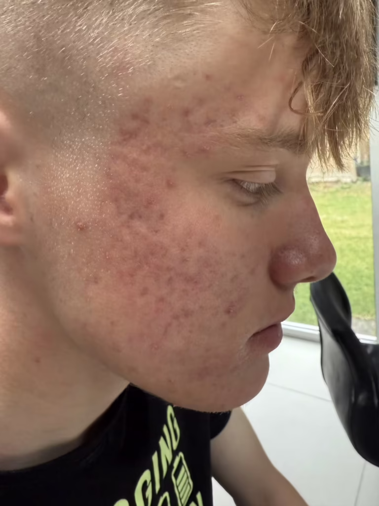 acne image 3 May